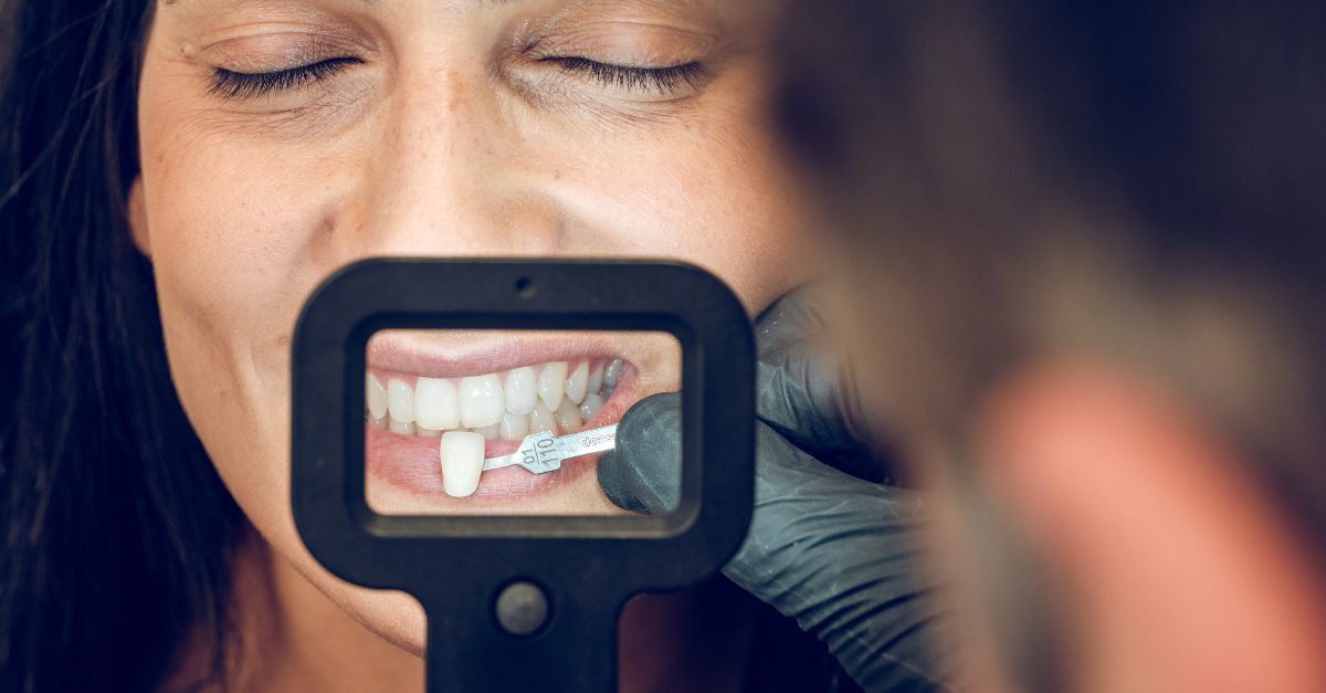 faccette dentali